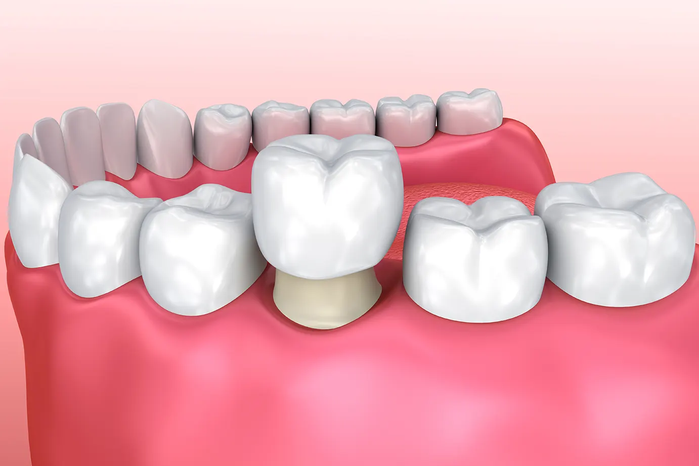 Dental Crowns in Downtown Austin | Primavera Dental Group