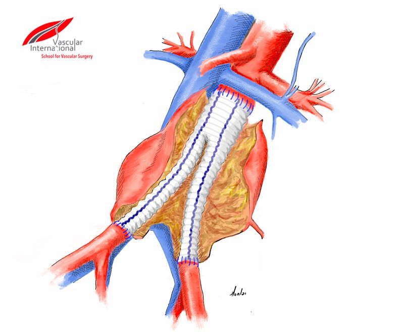 Vascular International | Abdominal Aortic Aneurysm (AAA): Bifurcated ...