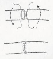end-to-end interrupted sutures