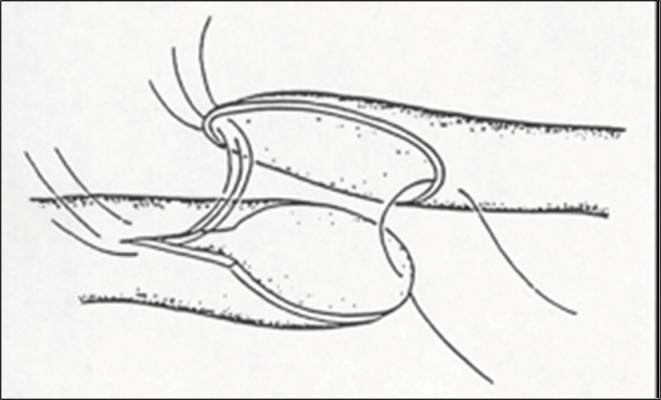oblique end-to-end running suture