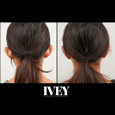 Side-by-side before and after photos showing the back of a woman's head with protruding ears corrected to lie closer to the head, demonstrating otoplasty results.
