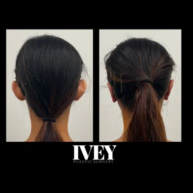 Side-by-side before and after photos of a woman’s head from the back showing reduced ear prominence after otoplasty surgery.