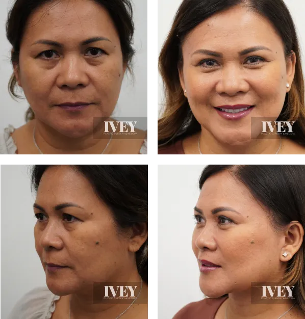 Before and after photos showing a woman's face from front and side views highlighting a smoother, refreshed appearance after cosmetic treatment.