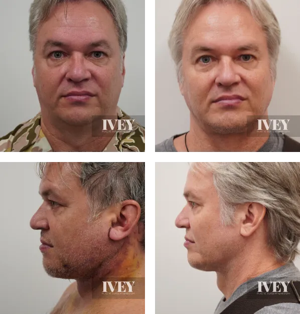 Before and after collage of a middle-aged man showing frontal and side views highlighting facial improvements post plastic surgery.