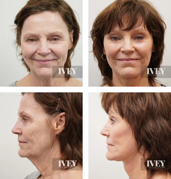 Before and after photos of a mature woman showing frontal and side views of her face with visible reduction in wrinkles and a smoother complexion after treatment.