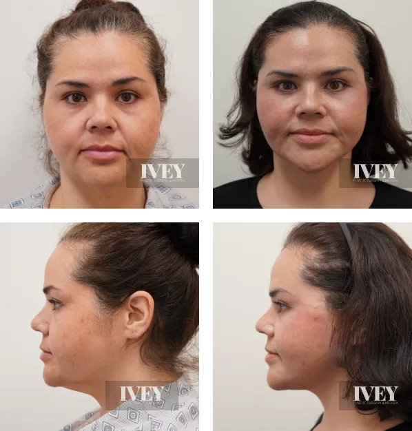Before and after comparison of a woman's face, showing front and side views with improvement in skin texture and facial contour.