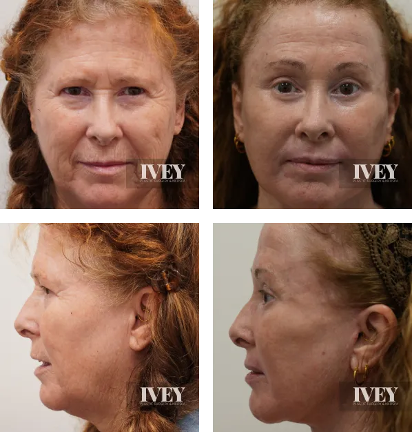 Before and after comparison of a middle-aged woman showing face and profile views; left images show the woman with natural aging signs, right images show a smoother, rejuvenated appearance post cosmetic procedure.