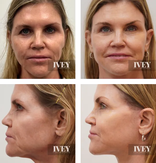 Before and after comparison of a middle-aged woman's face showing reduced wrinkles and smoother skin from front and side views.