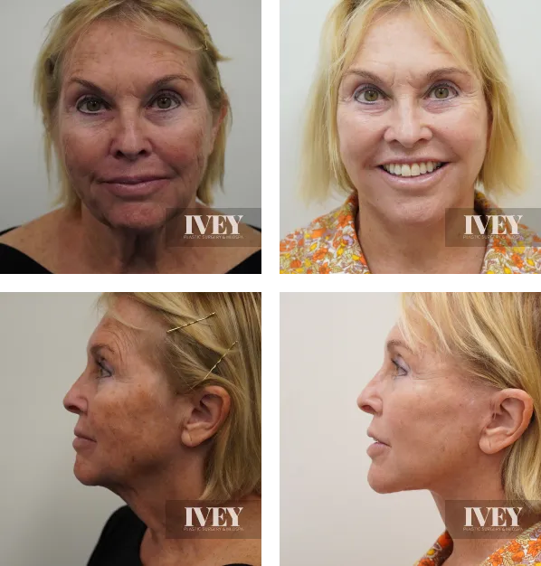 Before and after comparison of an older woman showing facial skin and contour improvements from front and side views.