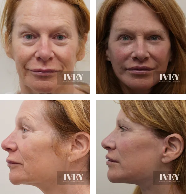 Before and after photos of a woman's face showing frontal and side views, illustrating reduced wrinkles and smoother skin after a cosmetic procedure.