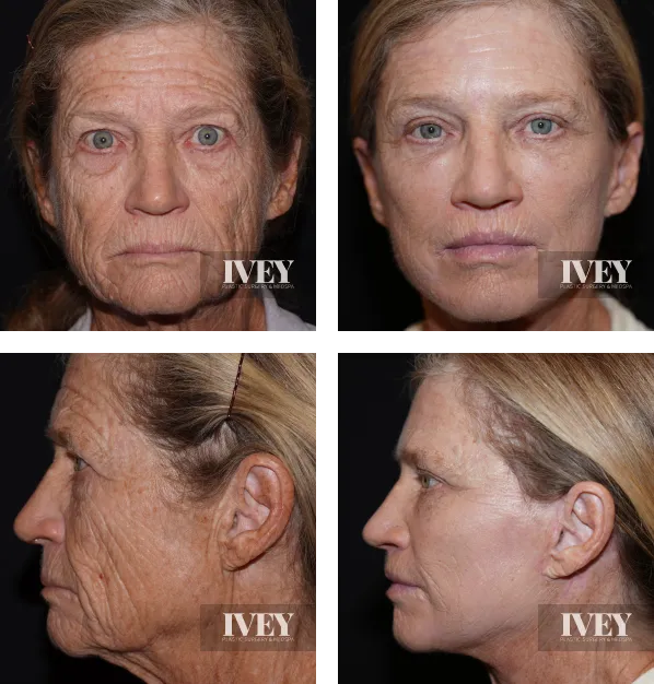 Before and after comparison of an older woman’s face and profile showing reduced wrinkles and tighter skin after cosmetic treatment.