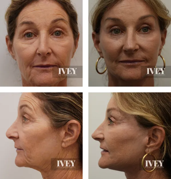 Side-by-side before and after comparison photos showing a woman's face from front and profile views, highlighting smoother skin and reduced wrinkles after cosmetic treatment.