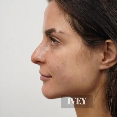 Close-up profile of a woman's face with natural skin texture and dark hair against a plain background.