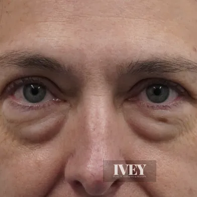 Close-up of a person's eyes showing prominent under-eye bags and wrinkles on the skin.