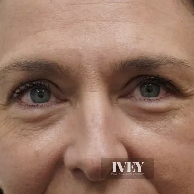 Close-up of a mature woman's face focusing on eyes, nose, and wrinkles around the eyes and forehead.