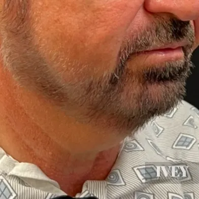 Close-up of the lower face and neck of a man with a trimmed beard and mustache wearing a patterned shirt.