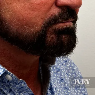 Close-up of a man's lower face showing a dark, thick beard and mustache, with a blue patterned shirt collar visible.