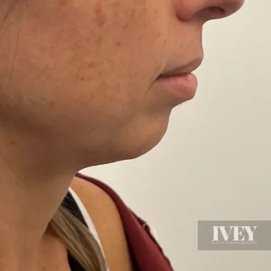 Close-up side profile of a woman's lower face and neck against a plain background.