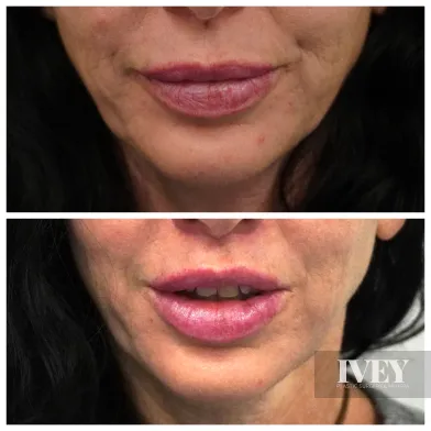Before and after close-up of a woman's lower face showing lips with increased fullness and definition after cosmetic treatment.