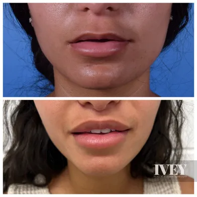 Before and after images showing a woman's lips and lower face; the top photo shows fuller lips with slight sheen, the bottom shows natural lips with a gentle smile.