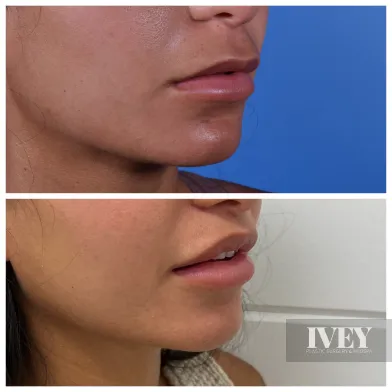 Side-by-side close-up views of a woman's lower face and lips showing a before and after comparison of skin texture and lip fullness.