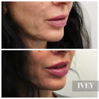 Before and after close-up of a woman's lower face showing lips and chin, with fuller lips in the after photo.