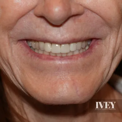 Close-up of an older person's smiling mouth showing clean, well-aligned teeth.