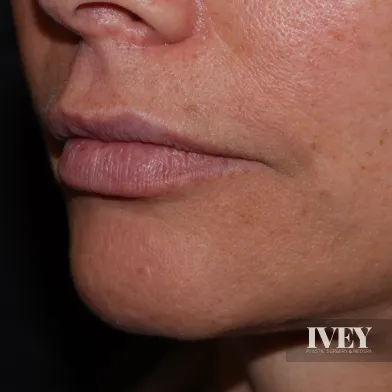 Close-up of a person's lower face showing smooth skin around lips, chin, and nose with natural texture.