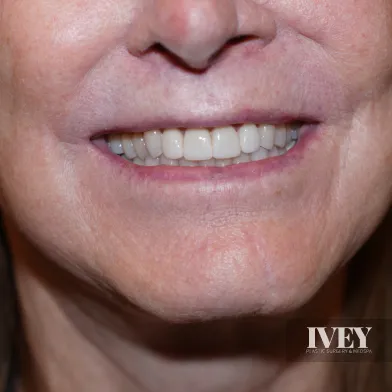 Close-up of a smiling mouth showing well-aligned, white teeth on mature skin.