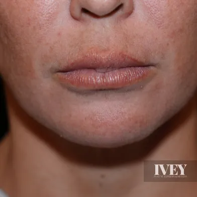 Close-up of lower half of a person's face showing lips, chin, and part of the nose with natural skin texture.