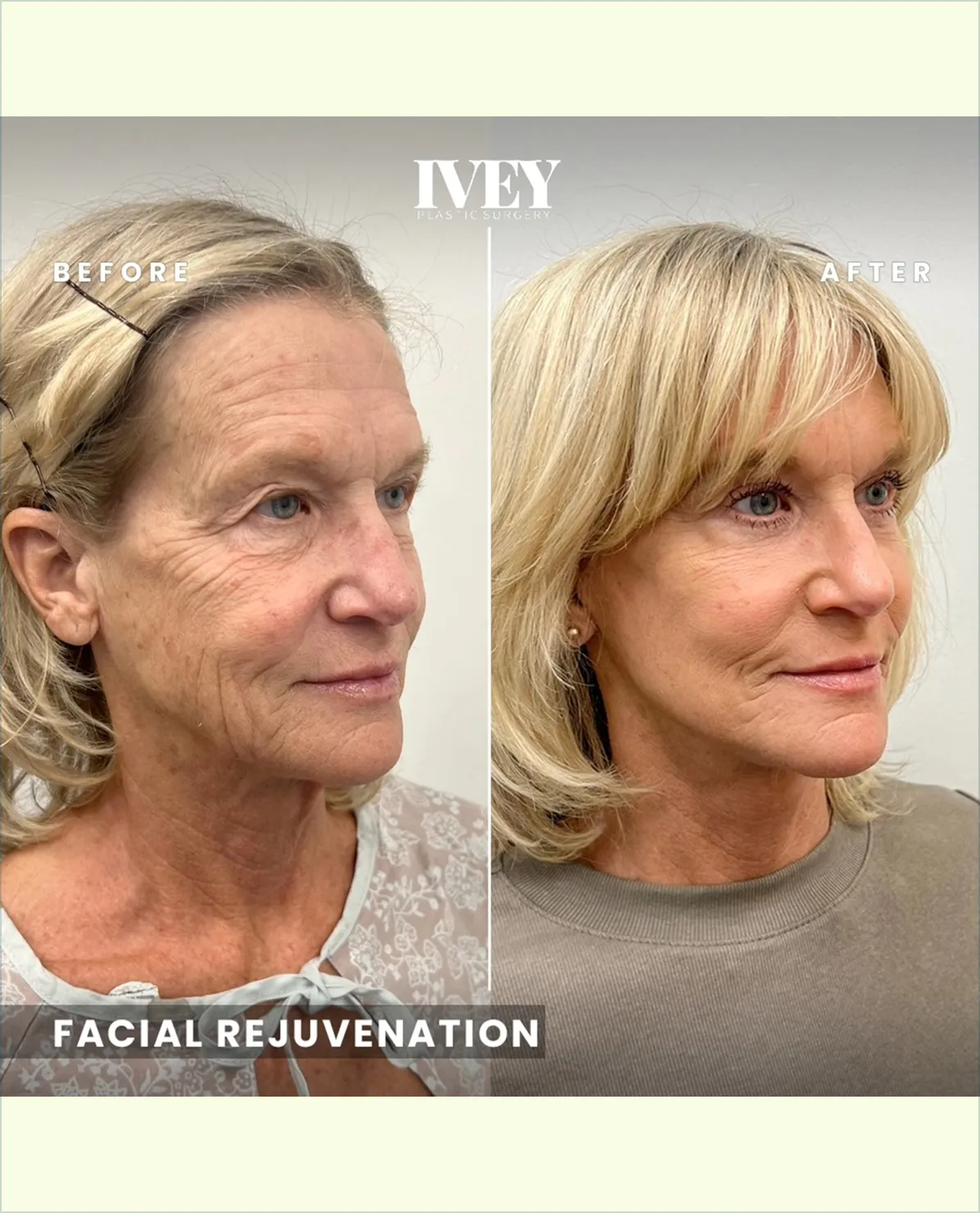 Side-by-side portrait of a woman before and after facial rejuvenation showing smoother skin and refreshed appearance.