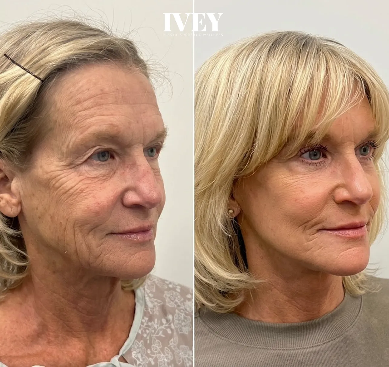Side-by-side before and after photos of a woman showing reduced wrinkles and smoother skin.