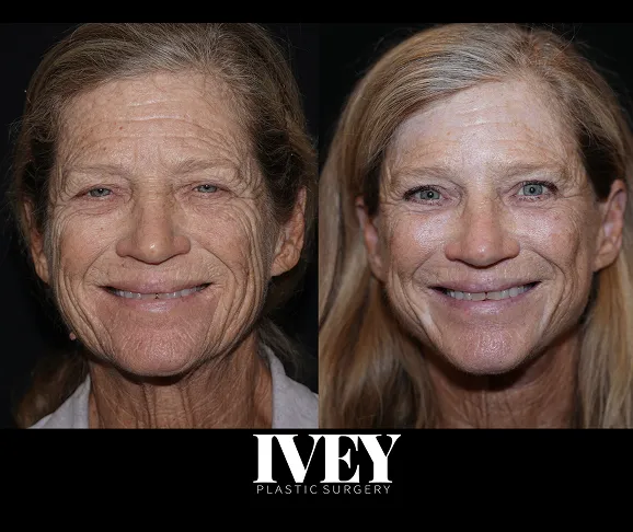 Side-by-side before and after photos of a woman's face showing smoother skin and lifted features after surgery.