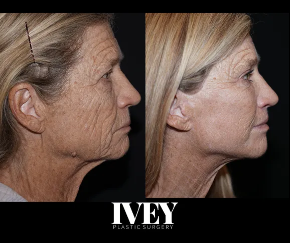 Side-by-side profile photos of an older woman before and after facial plastic surgery showing reduced wrinkles.