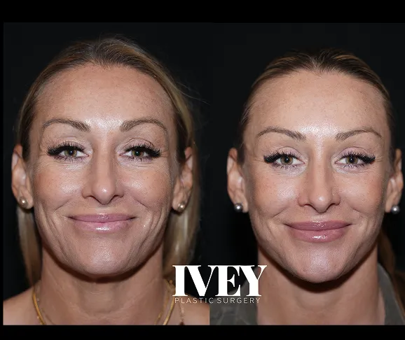 Side-by-side front portraits of a woman before and after plastic surgery, showing smoother skin and refined features.