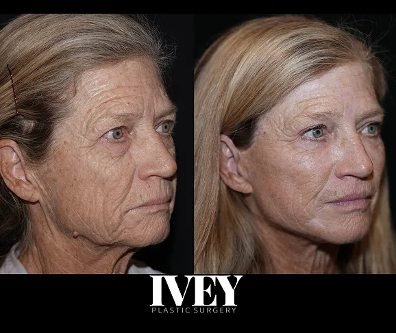 Side-by-side photos of a woman before and after plastic surgery showing smoother, less wrinkled skin.