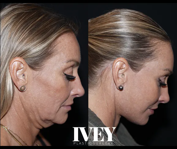 Side-by-side before and after photos of a woman's neck and chin after plastic surgery, showing reduced sagging.