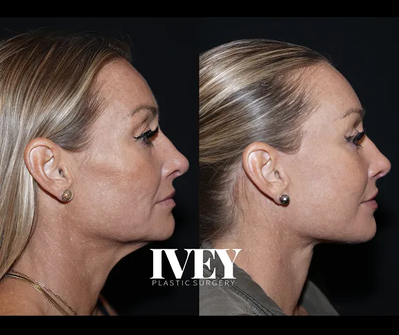 Side-by-side before and after profile photos of a woman showing facial contour improvement.