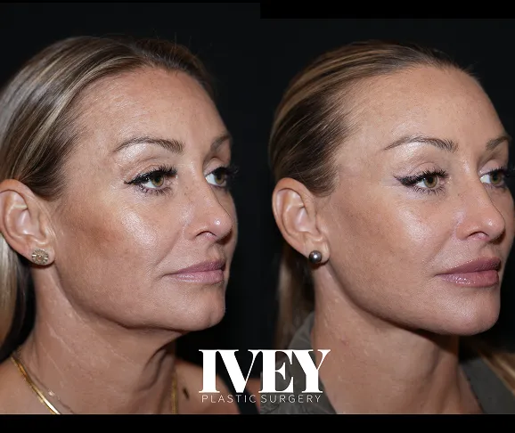 Side-by-side before and after photos of a woman's face showing smoother skin and refined nose shape.