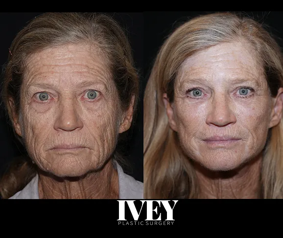 Side-by-side before and after photos of an older woman showing facial skin improvement after surgery.