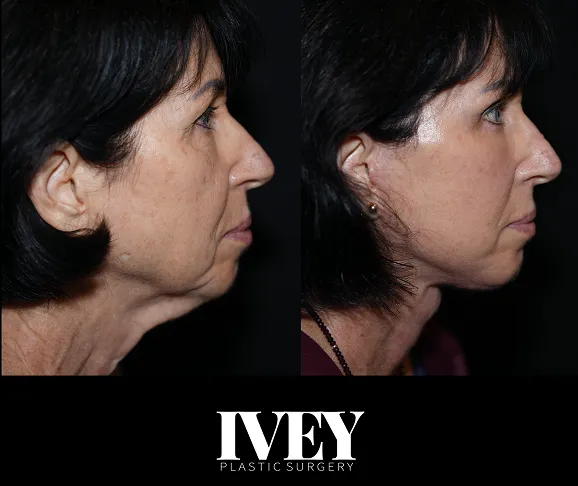 Side-by-side before and after profile images showing facial contour improvement on middle-aged woman.