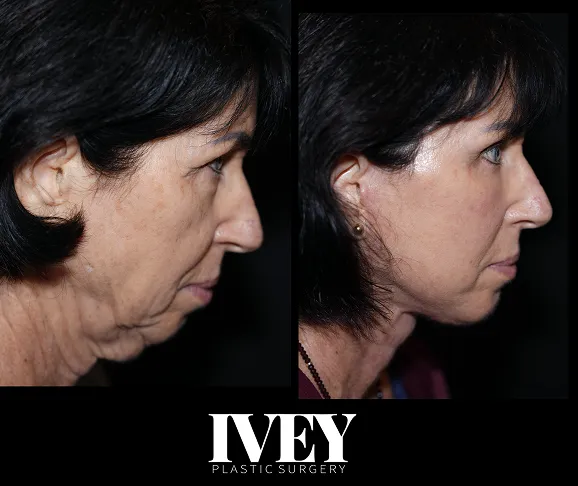 Before and after side profile images showing facial and neck rejuvenation of a middle-aged woman.