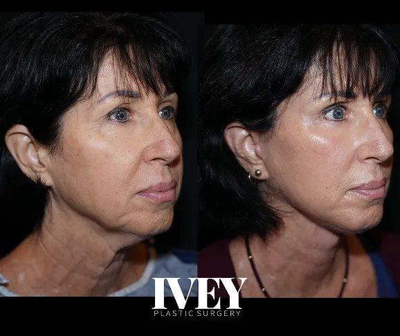 Before and after side-by-side photos of a woman's face showing smoother, tighter skin after plastic surgery.