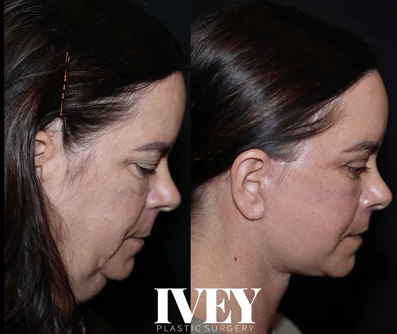 Side-by-side before and after photos of a woman's facial profile showing improved jawline and neck contour.