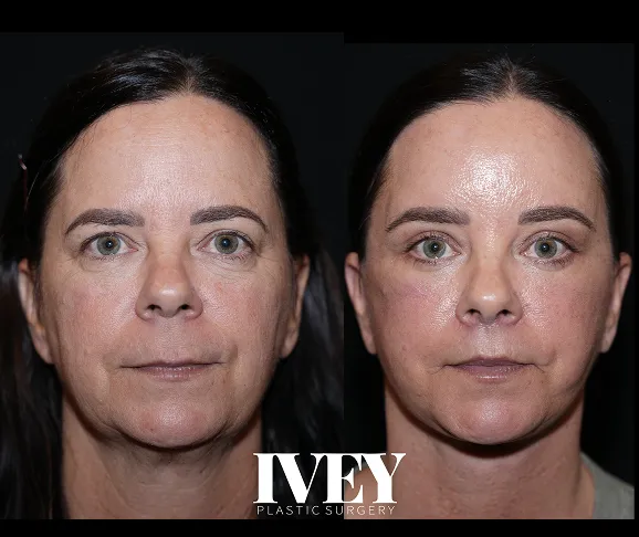 Side-by-side facial before and after photos of a woman showing skin and contour improvement.