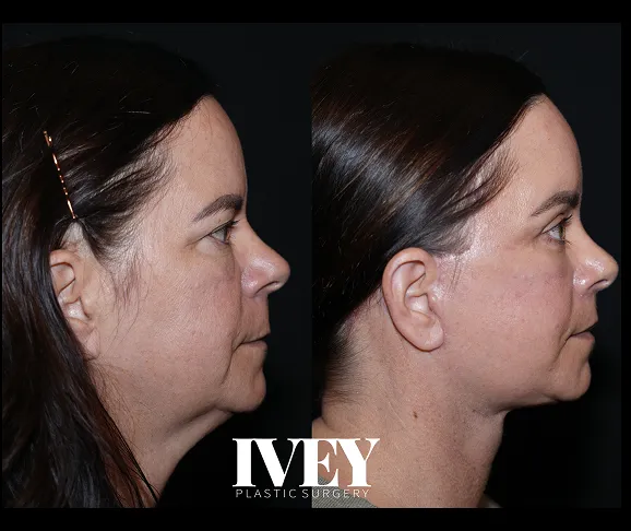 Side-by-side profile before and after images showing a woman's facial contour improvement post-surgery.