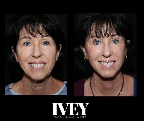 Side-by-side before-and-after photos of a woman's face, showing results of plastic surgery.