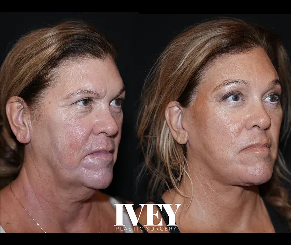 Before and after photos of a woman's face showing smoother skin and reduced wrinkles after surgery.