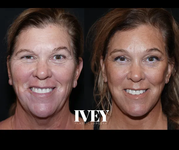 Side-by-side before and after close-ups of a woman’s face showing smoother skin and refined features after surgery.