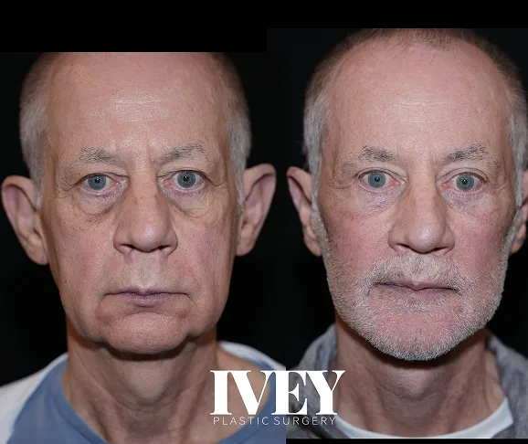 Side-by-side before and after close-up photos of a man’s face showing plastic surgery results.